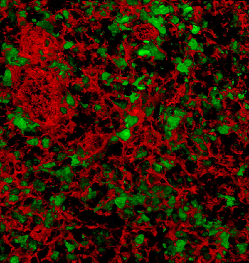 HSC gene therapy cystinosis